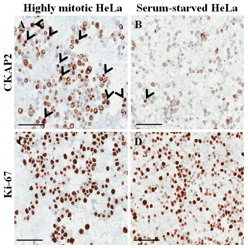 Figure 1. Immunocytochemical staining on paraffin-embedded cell block for HeLa cells. (Poojan S, et al., 2018)